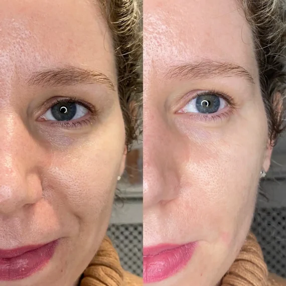 mid face thread lift before after side treatment sas aesthetics