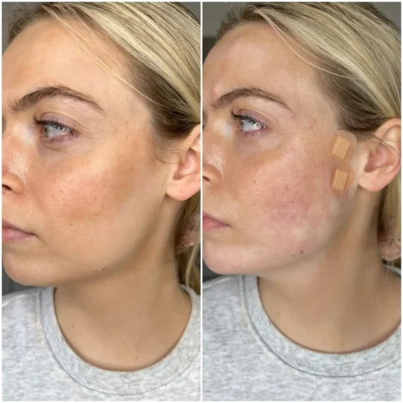 mid face thread lift before after treatment sas aesthetics