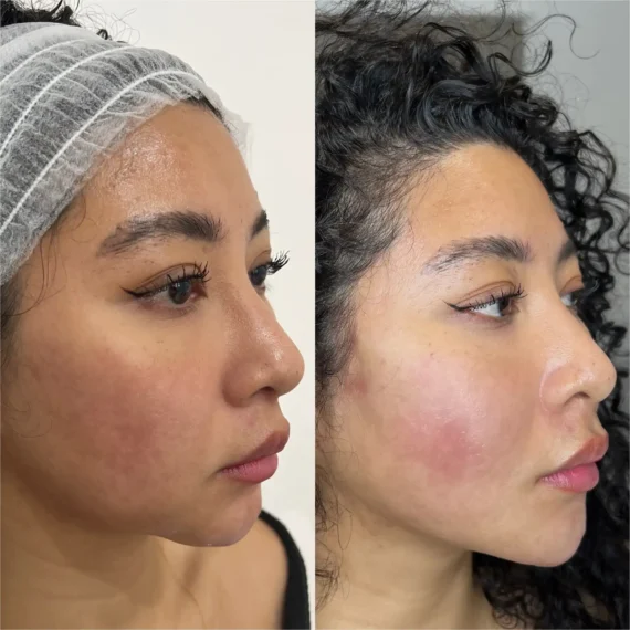 thread lift before after treatment sas aesthetics