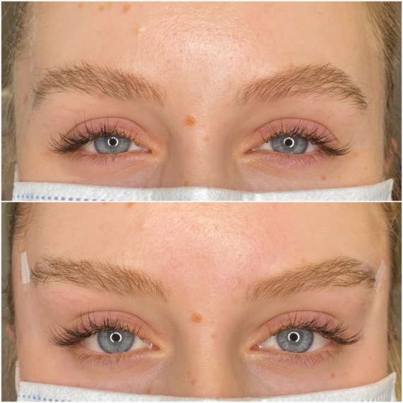 eyebrow lift sas aesthetics before after detail