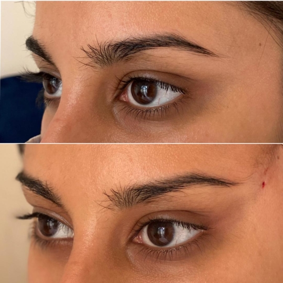 eyebrow thread lift before after sas aesthetics detail