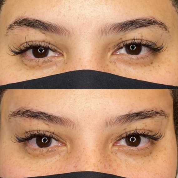 eyebrow thread lift before after sas aesthetics