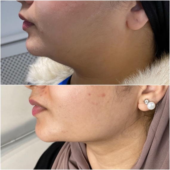 fat dissolving sas aesthetics before after