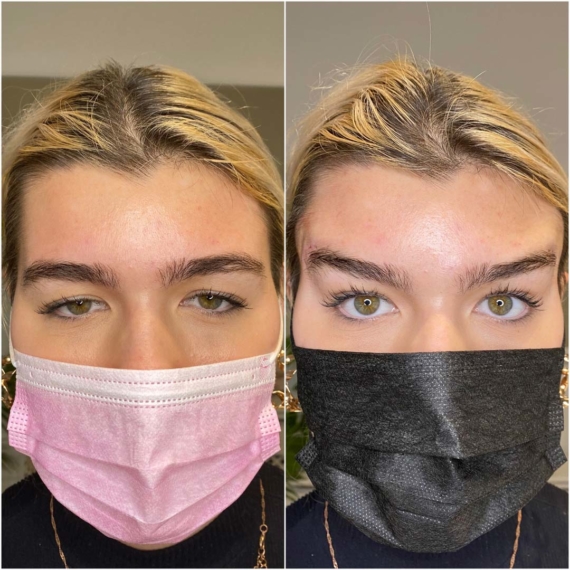 fox eyes thread lift before after sas aesthetics face mask