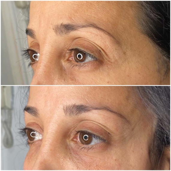 Fox Eyes Thread Lift London before after close up sas aesthetics