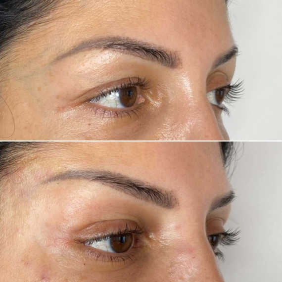 Fox Eyes Thread Lift London before after sas aesthetics