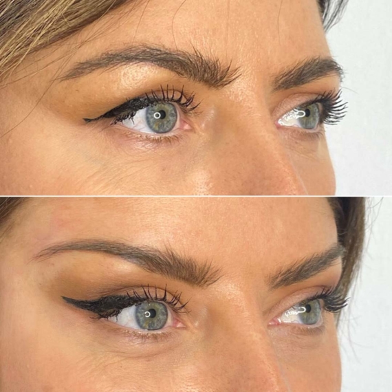 Fox Eyes Thread Lift London before after close up sas aesthetics