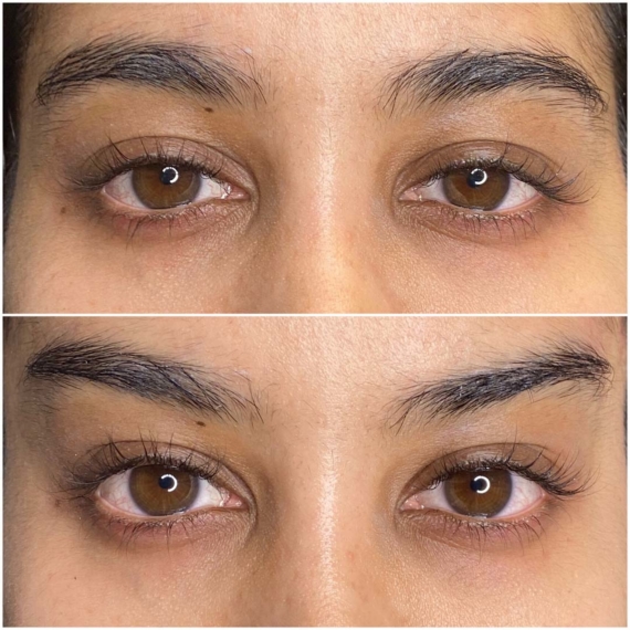 fox eyes thread lift before after sas aesthetics close up London