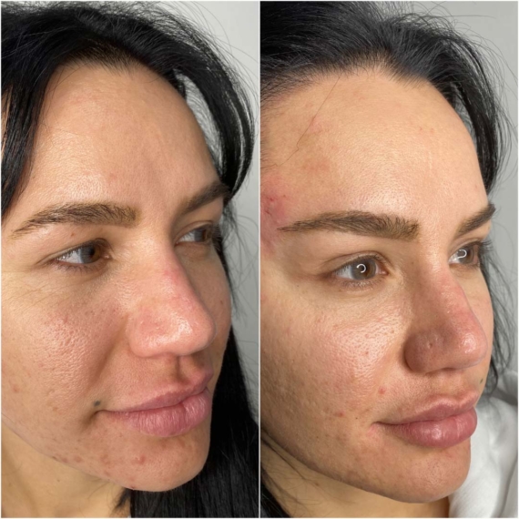 fox eyes thread lift before after sas aesthetics side profile