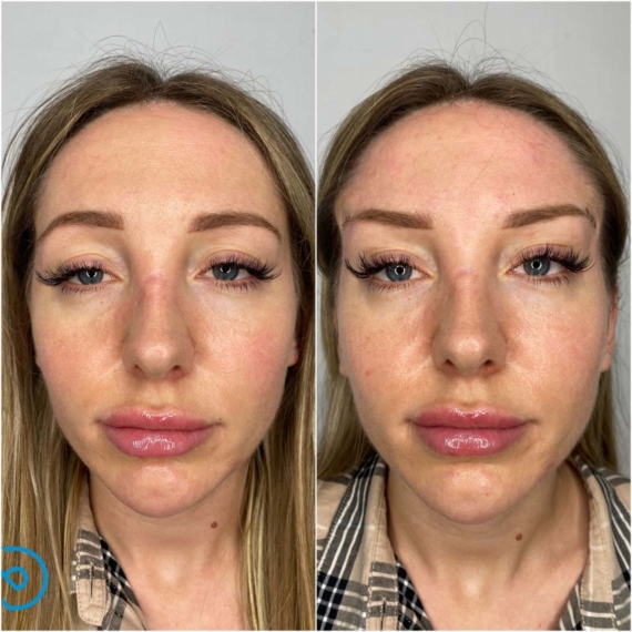 fox eyes thread lift before after sas aesthetics profile