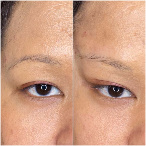 fox eyes thread lift before after sas aesthetics single eye