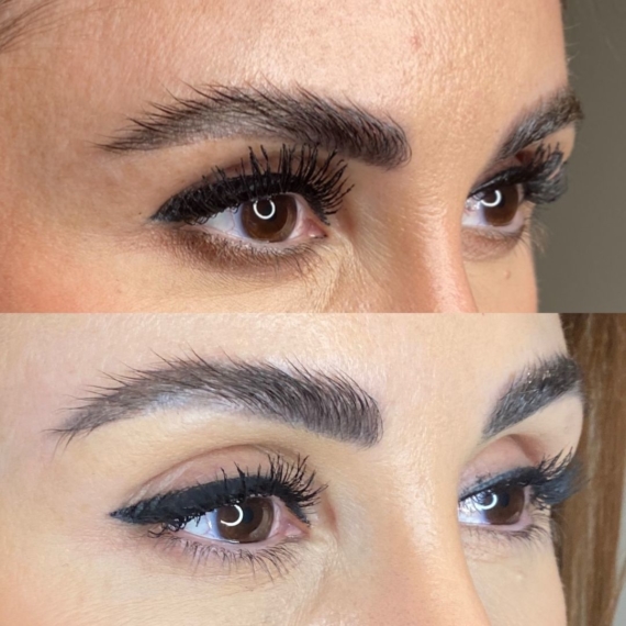 fox eyes thread lift before after sas aesthetics side view London