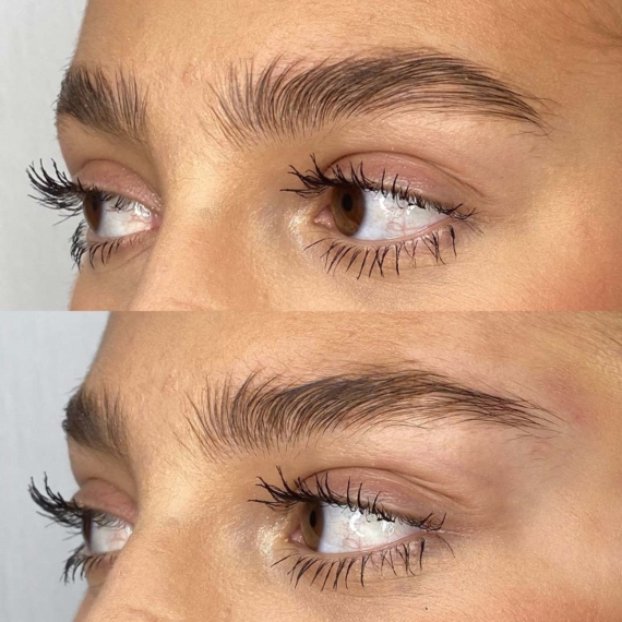 fox eyes thread lift before after sas aesthetics close up