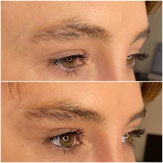 fox eyes thread lift before after sas aesthetics