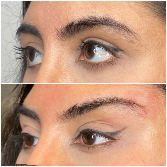 Fox Eyes Thread Lift London before after sas aesthetics