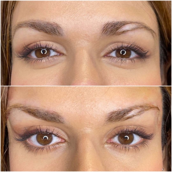 Fox Eyes Thread Lift London before after sas aesthetics