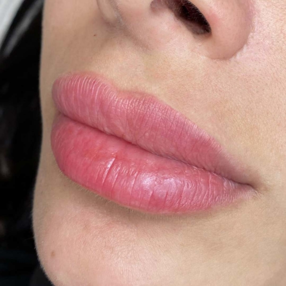 Lip Filler Augmentation in London sas aesthetics