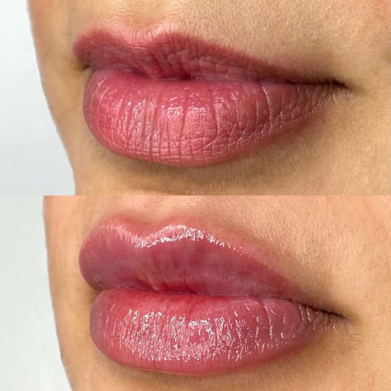 Lip Filler Augmentation SAS Aesthetics