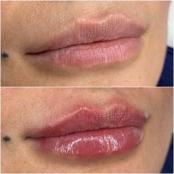 Lip Filler Augmentation London sas aesthetics