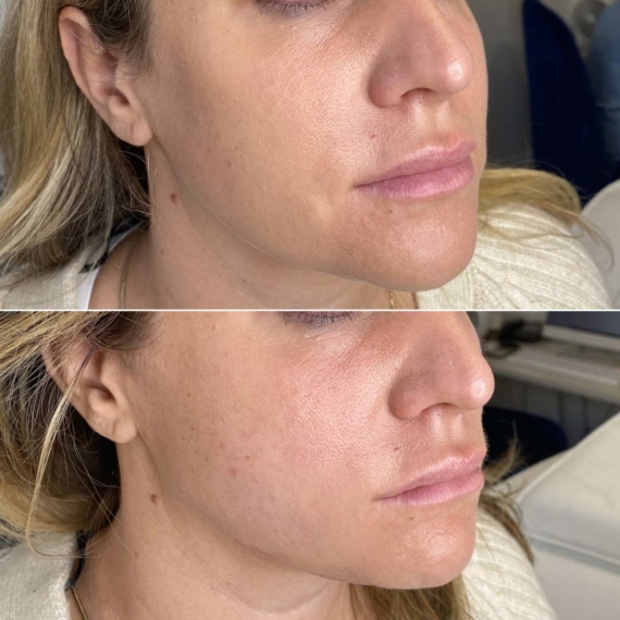 Best Lower Face ThreadLift sas aesthetics