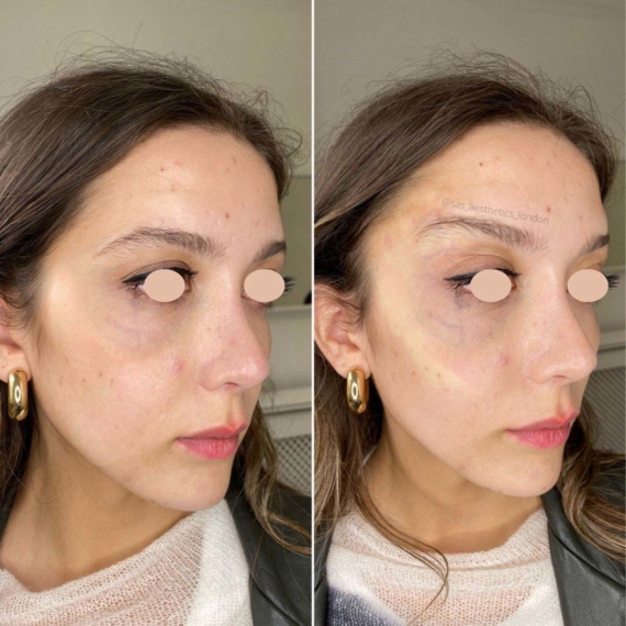 mid face thread lift sas aesthetics before after