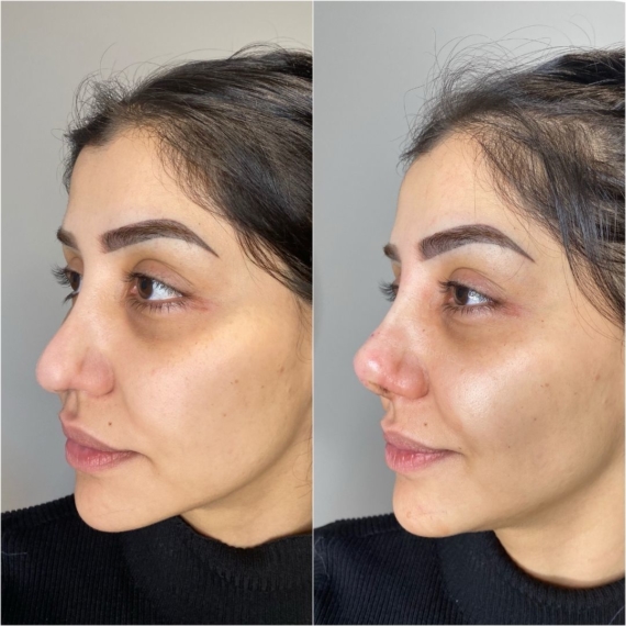 Best Nose Thread Lift London sas aesthetics before after