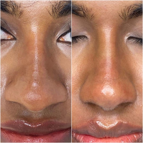 nose thread lift sas aesthetics before after detail front