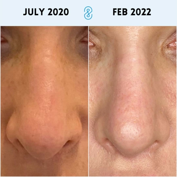 nose thread lift sas aesthetics before after detail