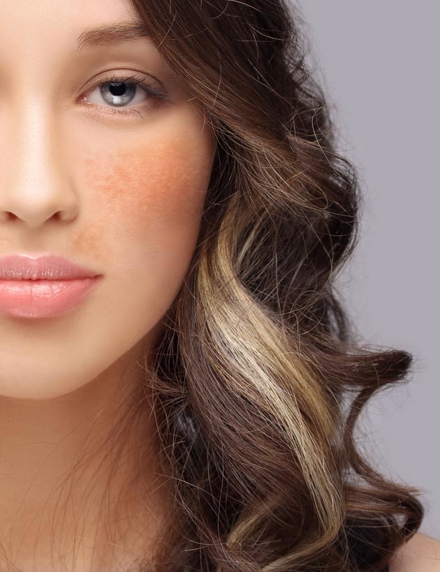 hyperpigmentation treatment sas aesthetics