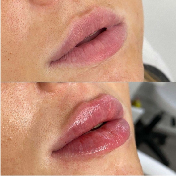 Lip Filler augmentation London sas aesthetics