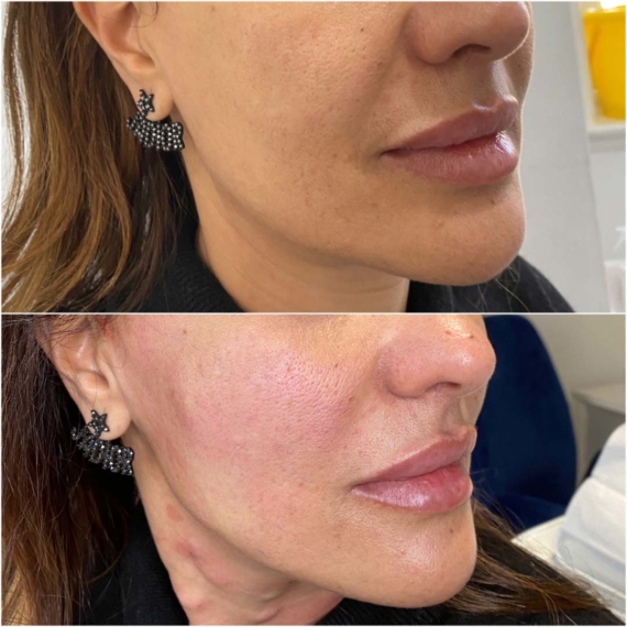 Lower Face ThreadLift before after sas aesthetics