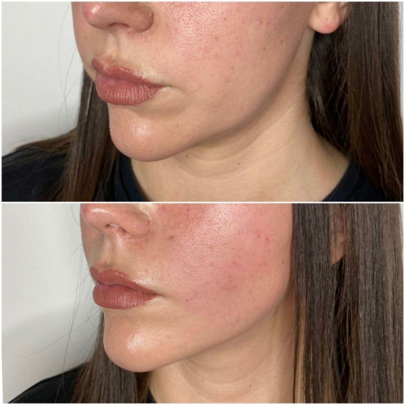 lower face thread lift before after sas aesthetics