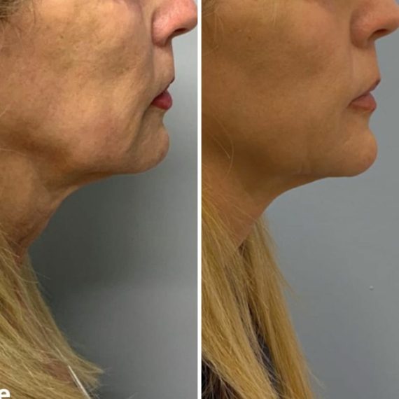 woman chin sofwave treatment before after lower face sas aesthetics