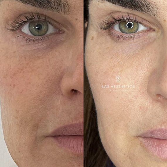 Full Face Rejuvination 3-min before after sas aesthetics