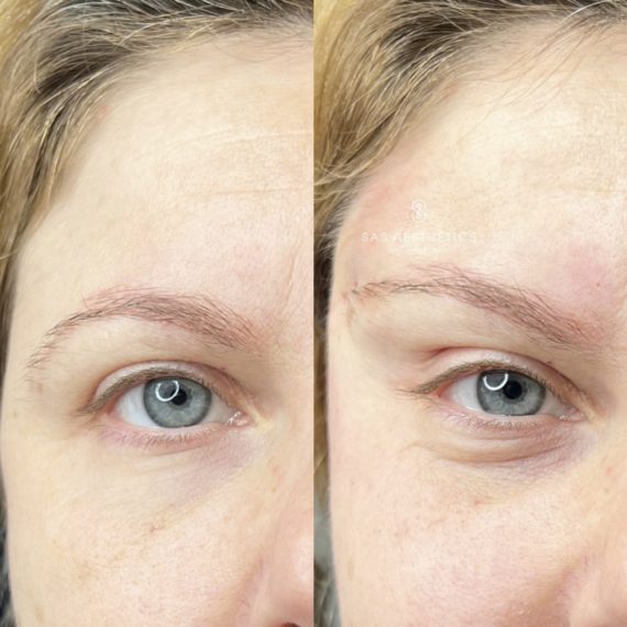 threadlifts eye woman before after nose sas aesthetics