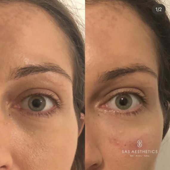 close up threadlifts eye woman before after nose sas aesthetics