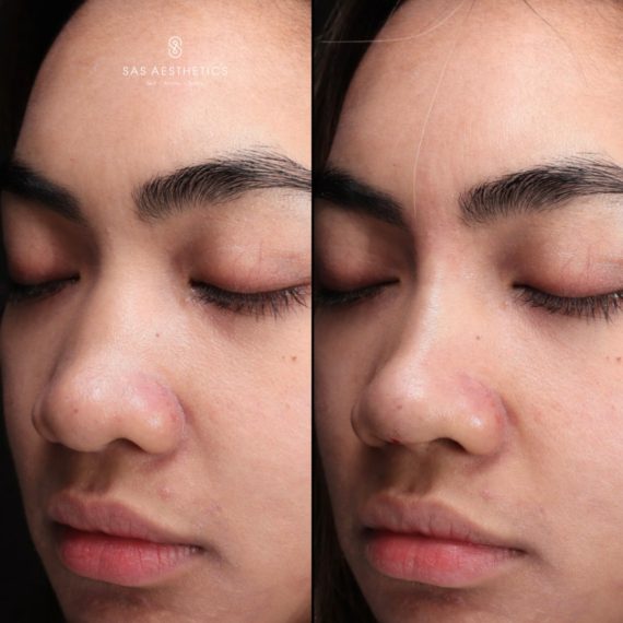 threadlifts before after nose sas aesthetics